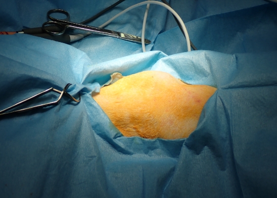 甲状腺腫瘍、手術の様子