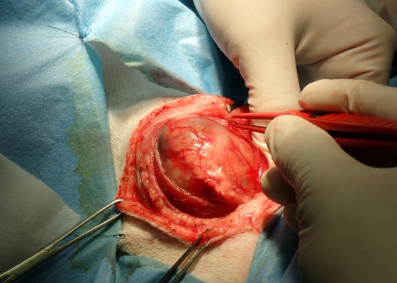 甲状腺腫瘍、手術の様子