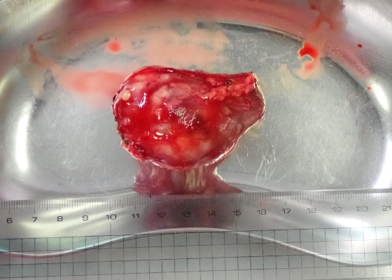 甲状腺腫瘍、手術の様子